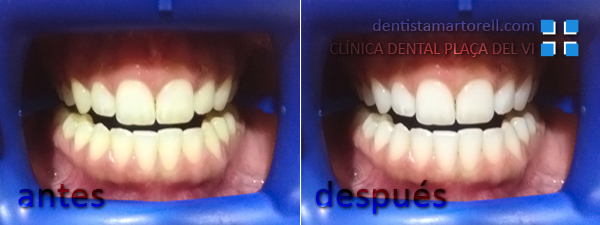 Blanqueamiento Dental en la Clínica Dental Plaça del Vi de Martorell